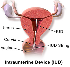 IUD Contraceptive